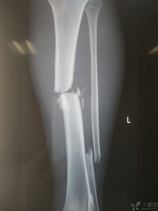 科技重塑脛腓骨骨折康復之旅，引領(lǐng)未來(lái)體驗新篇章