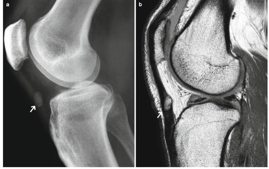 髕腱炎成為醫學(xué)焦點(diǎn)，從幕后走向舞臺中央的最新進(jìn)展