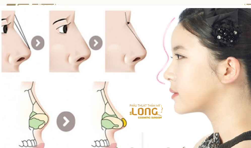 最新鼻整形技術(shù)重塑自信，煥發(fā)新生之美