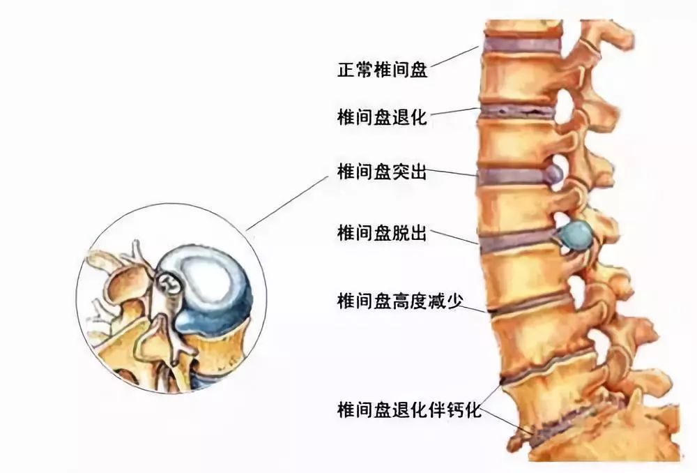 最新腰椎盤(pán)與歡樂(lè )大家庭的互動(dòng)日常