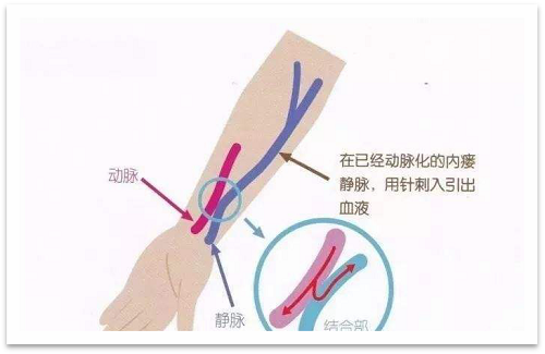 靜脈瘺最新資訊，掌握最前沿的健康信息